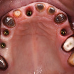 Valutazione estetica e funzionale dei restauri in zirconia realizzati con tecnica tradizionale e tecnologia CAD/CAM