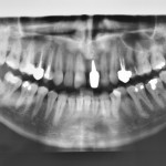 Rigenerazione ossea guidata con griglie in titanio in settore estetico xCase report rigenerazione ossea guidata