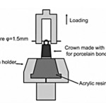 La cementazione provvisoria delle corone su impianto: caratteristiche e metodiche per la sua rimozione