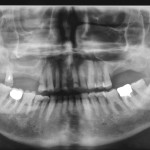 Rimozione di cisti mucose del seno mascellare in associazione all’elevazione del pavimento sinusale: una nuova tecnica micro-invasiva con accesso intra-orale