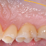 Attuale utilizzo del prelievo epitelio-connettivale in chirurgia mucogengivale