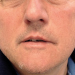 Enucleazione chirurgica di grossa cisti mascellare superiore in anestesia generale