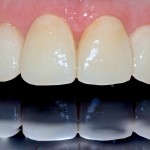 Faccette dentali: indicazioni, progettazione e realizzazione faccette dentali