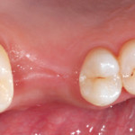 Ponte su intarsi inlay: quale materiale utilizzare?