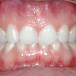 Trattamento ortodontico mediante metodica Invisalign® finalizzato con faccette in ceramica