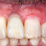 Conservazione della vitalità pulpare in dente con riassorbimento radicolare. Un caso complesso