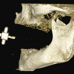 Dalla diagnosi 3D alla protesi finita: utilizzo delle tecnologie digitali per il trattamento avanzato del paziente