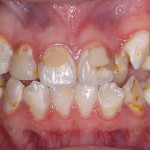 Cambiare un sorriso, e la vita, con l’odontoiatria minimamente invasiva