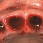 Studio clinico preliminare sulla prevedibilità dell’estetica ideale: ruolo di un nuovo design implantare Bone Level