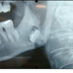 Osteonecrosi da bifosfonati della mandibola con disodontiasi del 3.8 osteonecrosi-da-bifosfonati-della-mandibola-con-disodontiasi-del-3-8