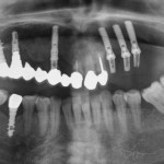 La gestione di un caso complesso implantare: dall’analisi pre-operatoria alla realizzazione della protesi definitiva