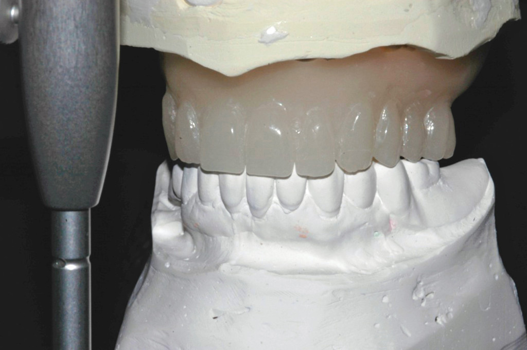 Chirurgia implantare guidata per il mascellare edentulo