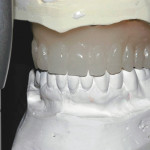 Chirurgia implantare guidata per il mascellare edentulo Chirurgia implantare guidata per il mascellare edentulo