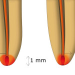 Utilizzo dei laser in endodonzia