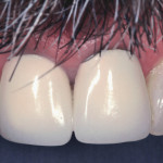 Preservazione dei livelli di tessuto molle con riabilitazione implantare provvisoria immediata