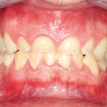 Faccette palatali e frontali per il trattamento dell’erosione dentale grave: caso clinico con tecnica three step e approccio sandwich