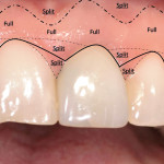 Un nuovo approccio chirurgico per aumentare lo spessore dei tessuti molli all’inserimento degli impianti in zone estetiche