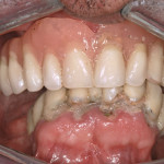 La protesi inferiore fissa impianto-sostenuta in un caso di II classe scheletrica Caso clinico