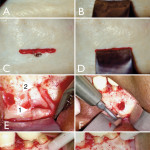 Microchirurgia endodontica