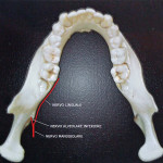 Neuropatie in odontoiatria: i maggiori rischi sono per nervo linguale e alveolare inferiore Lesione del nervo linguale in seguito a chirurgia dei terzi molari odontoiatria