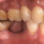 Utilizzo di impianti in ossido di zirconio per il trattamento di edentulie nei settori premolari Case report