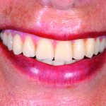 Quali materiali in protesi fissa oggi?