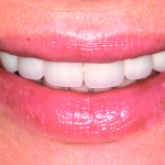 Riabilitazione estetica con disilicato di litio e cementazione adesiva. Caso clinico