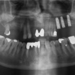 Riabilitazione estetica dei settori frontali con impianti in zirconio di ultima generazione