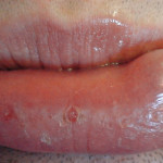 Mucocele del labbro inferiore: un caso clinico