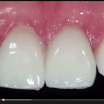 Esthetic Rehabilitation of Anterior Teeth with Veneers veneers