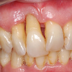 Aumento verticale di cresta mediante innesto autologo in zona estetica