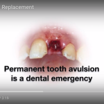 Management of an avulsed permanent tooth Avulsed. Permanent Tooth