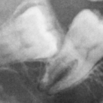 Disodontiasi del dente del giudizio: inquadramento cIinico disodontiasi ottavo dente del giudizio