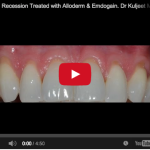 Recessione gengivale: classificazione e approccio al trattamento recessione gengivale trattamento