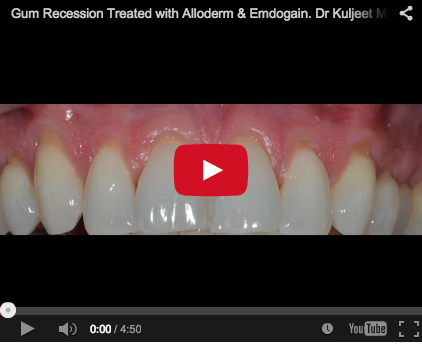 recessione gengivale trattamento