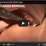 Laserterapia & odontoiatria: applicazioni del laser erbium laser erbium laserterapia odontoiatria