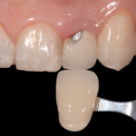 Metodi di riparazione intraorale di protesi fisse: procedure tecniche e cliniche Protocolli di riparazione adesiva di protesi fisse