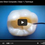 Posterior direct composite: first class technique video composito, nanoriempito, nanofibre posterior first class molar composite