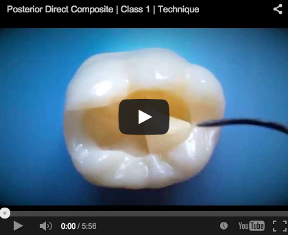composito, nanoriempito, nanofibre posterior first class molar composite