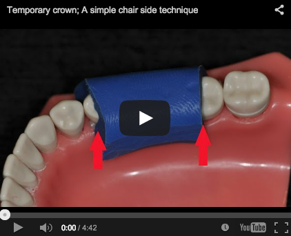 Temporary crown, a simple direct technique