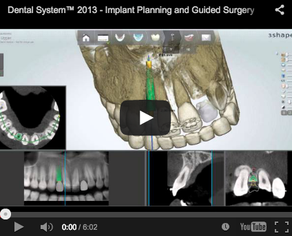 implantologia guidata chirurgia guidata