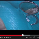 Endodontic tips for working length and apex locator accuracy Endodontic tips for working length and apex locator accuracy