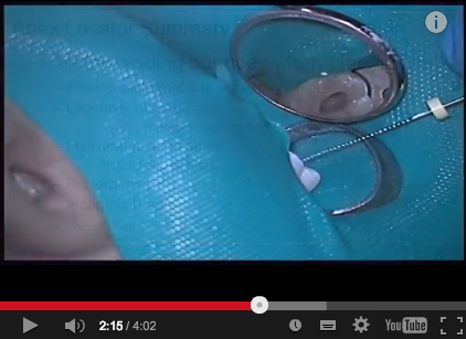 Endodontic tips for working length and apex locator accuracy