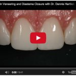 Estetica: chiusura di diastema tramite faccette in composito faccette in ceramica-diastema