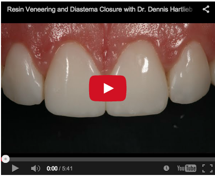 faccette in ceramica-diastema