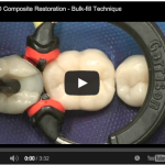 Ricostruzione MOD con composito Bulk composito bulk ricostruzione conservativa