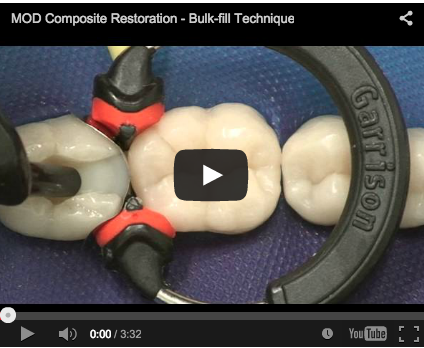 composito bulk ricostruzione conservativa