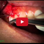 Trattamento di recessione gengivale con tecnica caf CAF trattamento recessione gengivale