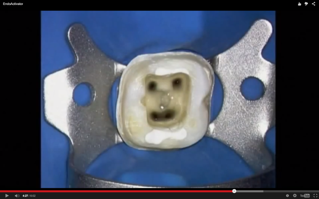 endodonzia apertura canalare camera pulpare devitalizzazione