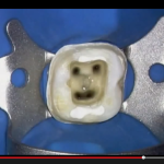 Reperimento, alesatura e disinfezione canalare in endodonzia endodonzia apertura canalare camera pulpare devitalizzazione